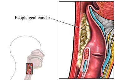 Fumonisins are associated with esophageal cancer